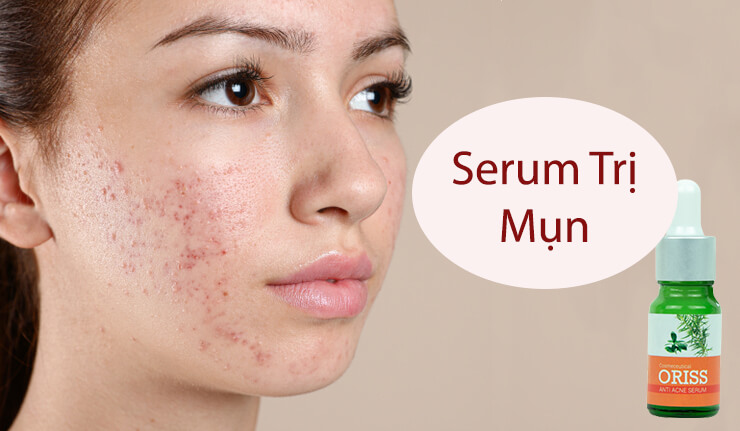 Serum trị mụn